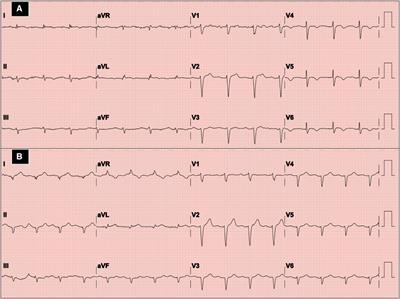 Case Report: Asymptomatic SARS-COV2 infection triggering recurrent Takotsubo syndrome